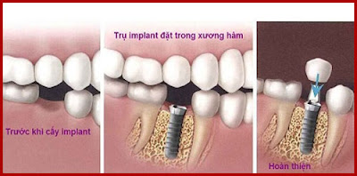 Cấy ghép răng implant là phương pháp gì?