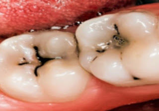 Can tooth Cavities cause Bad Breath