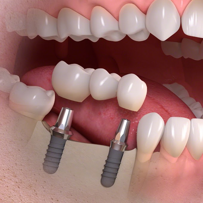 Tooth Replacement Solution with Dental Implants