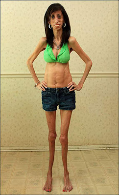 Wanita Terkurus Di Dunia, Di Amerika, Texas, Lizzie Velasquez, Mahasiswa Komunikasi, Neonatal Progeroid Syndrome, sindrom,Wanita Terkurus Sedunia