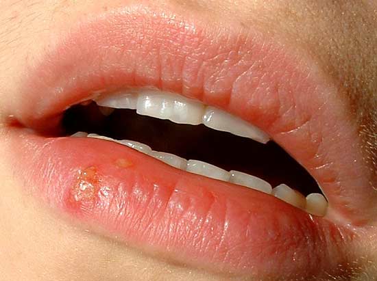 Cara Mengobati Herpes Di Tangan