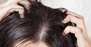 How to Treat Dandruff?