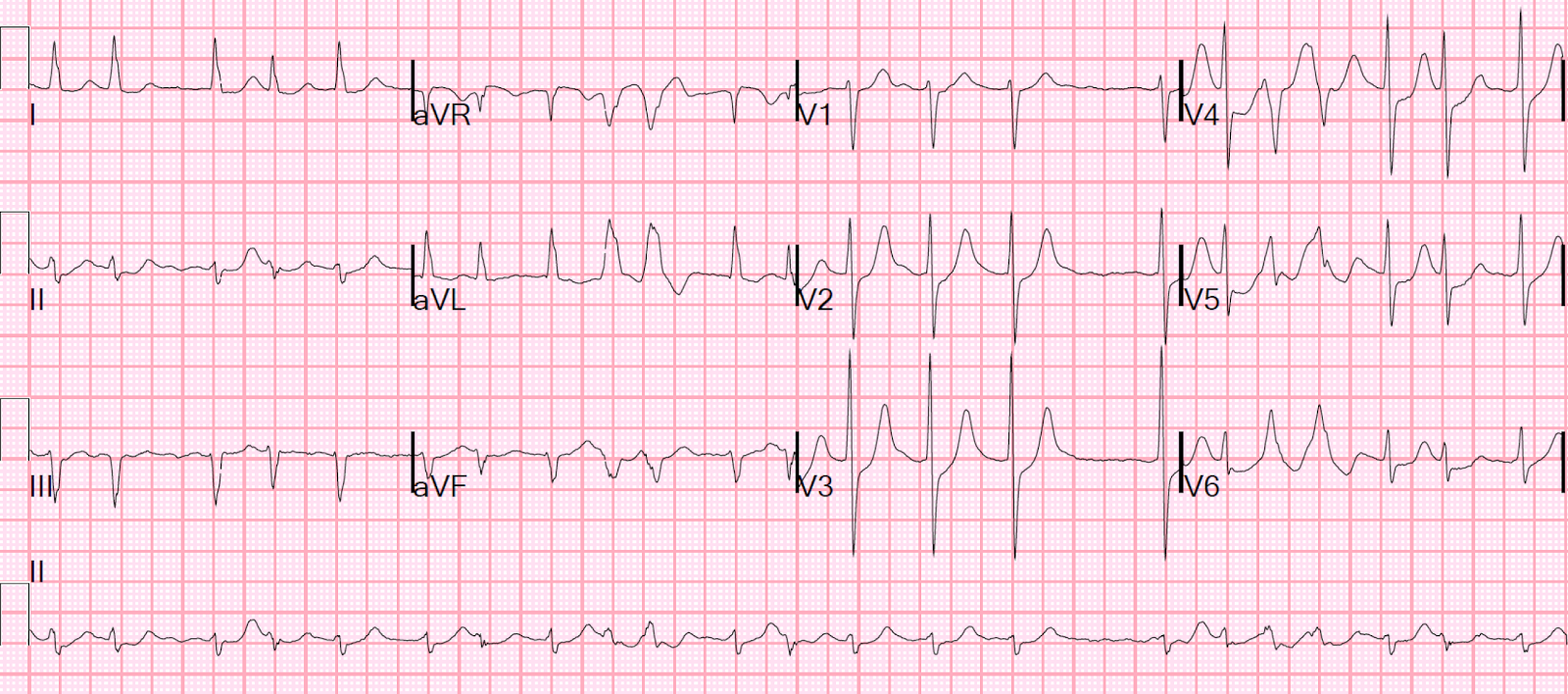 Dr Smith S Ecg Blog Atrial Fibrillation With Rvr Use Pocus To Assess Volume Then Sinus Vs Svt Use Of Lewis Leads Dr Smith S Ecg Blog Atrial Fibrillation With Rvr Use Pocus To Assess Volume Then Sinus Vs Svt Use Of Lewis Leads