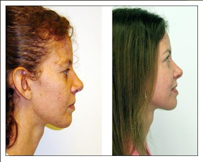 Chin Implants Before And After