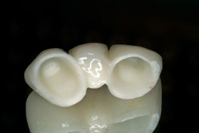 Những điều gì làm nên ưu điểm của răng sứ Venus?