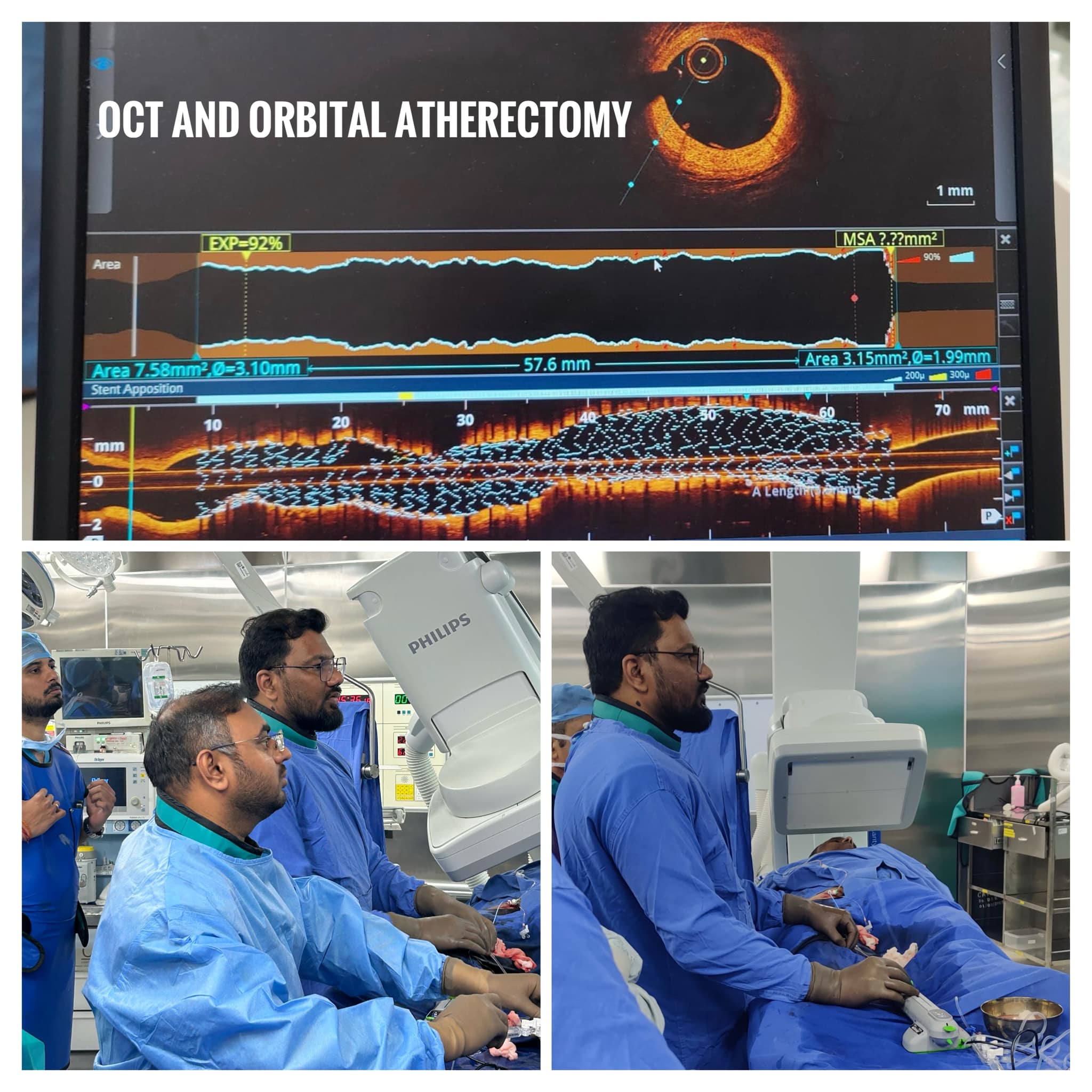 Complex Successful Angioplasty with Critical Triple Vessel Disease by Dr Harshal Ingle