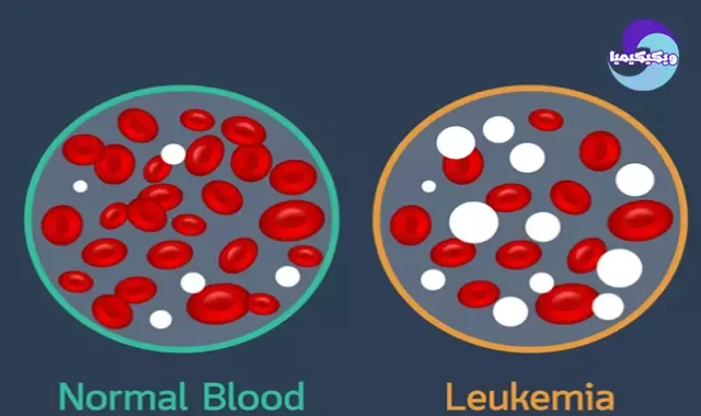 سرطان الدم - ابيضاض الدم