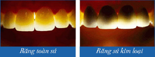 Răng kim loại dễ bị ảnh hưởng bởi ánh sáng môi trường bên ngoài hơn