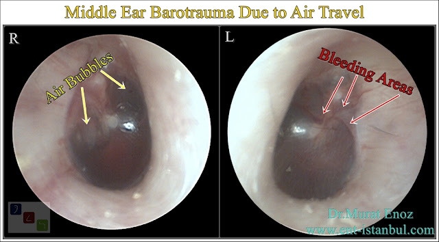 Barotrauma related middle ear disesase,Airplane Ear,Otalgia,Barotraumatic eardrum damage,Ear pain,Earache,