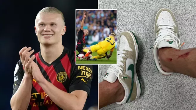 Erling Haaland shows off nasty cuts to leg after Man City’s draw at Brighton