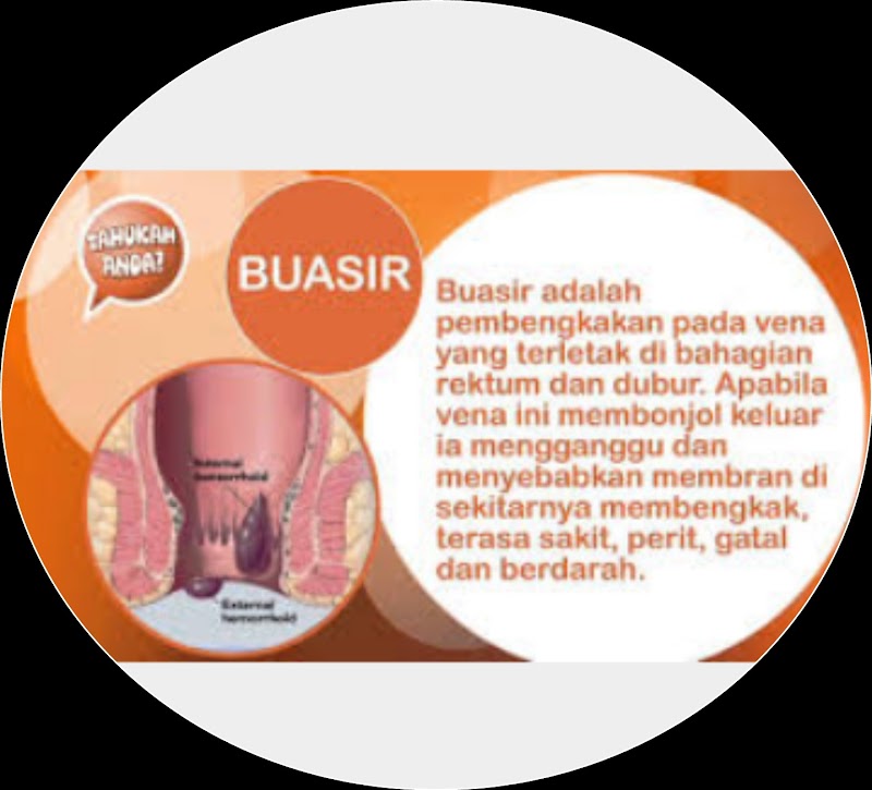 Rawatan alternatif untuk Buasir