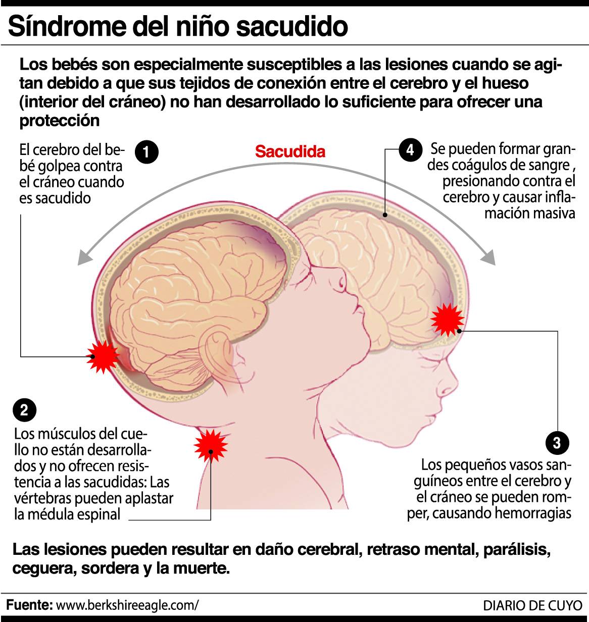 Ems Solutions International By Drramonreyesmd Marca Registrada Sindrome Del Bebe Sacudido Sbs Shaken Baby Syndrome Sindrome Bebe Zarandeado Lesion Cerebral Traumatica En Ninos