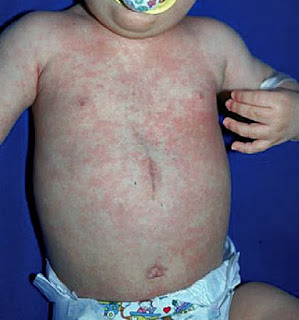  rashes and fever caused due to the Roseola infantum disease pictures