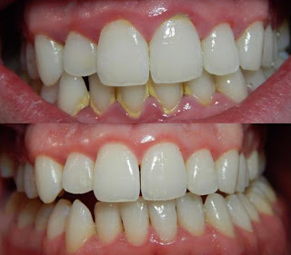 A gingivitis has a plaque buildup tartar which requires professional intervention to be removed thoroughly pictures