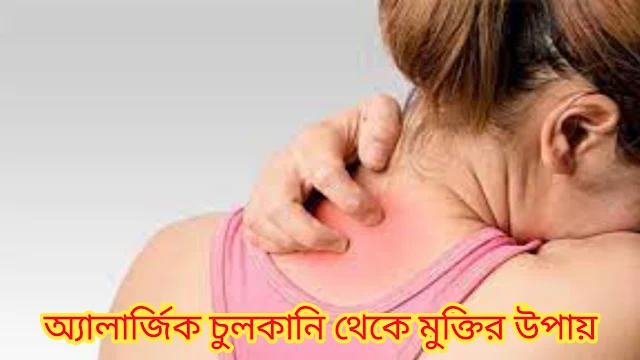 অ্যালার্জিক চুলকানি দূর করার কার্যকরী কৌশল - Effective strategies to relieve allergic itching