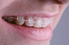 Ceramic Braces