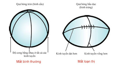   Mắt bị loạn thị cần được bổ sung loại thuốc bổ mắt, viên sáng mắt có nguồn gốc xuất xứ rõ ràng