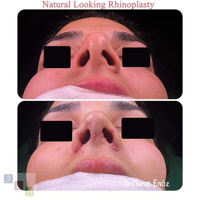 subtle enhancements,Istanbul aesthetic procedure,Istanbul natural rhinoplasty,natural-looking results,harmonious nose job.,Turkey organic nose surgery,skilled surgeons,