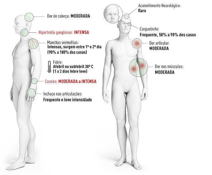 ZIKA VÍRUS:O QUE É, CAUSAS, SINTOMAS, TRATAMENTO, DIAGNÓSTICO E PREVENÇÃO