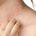 Avoid Extreme Eczema Outbreaks