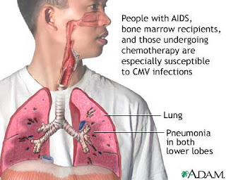 pneumonia_pada_anak