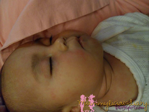 heat rash on babies pictures. heat rash baby face. aby heat