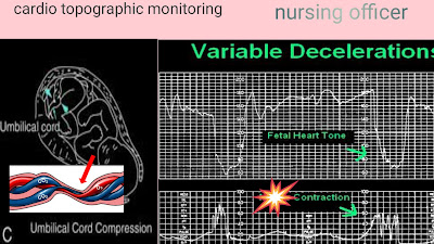 non stress test vs contraction stress test, non stress test procedure, fetal cardiotocography