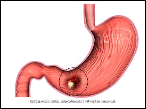 Stomach Cancer