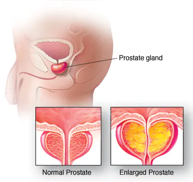 4 Ways to Treat Benign Prostatic Hypertrophy at Home