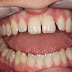 Niềng răng có những ưu điểm gì?