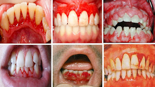 علاج خراج اللثة والأسنان بالطب البديل