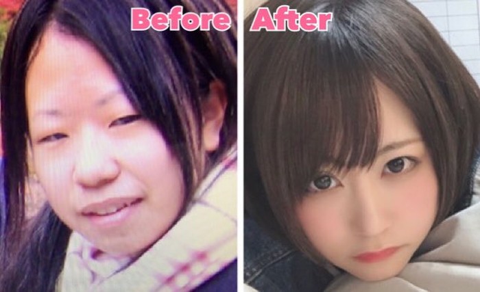 Posting Foto Sebelum dan Sesudah Operasi Plastik, Wanita Ini Bikin Netizen Tercengang