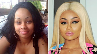 did black chyna have surgery,