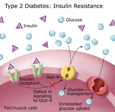 Type 2 Diabetes Insulin Resistance