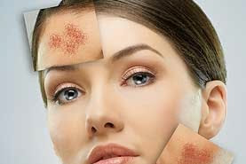 Acne and Rosacea Treatment