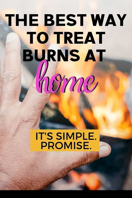 10 Natural Remedies to Treat Burns At Home