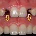  Cấy ghép Implant khi mất nhiều răng