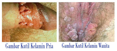 obat kutil kelamin