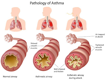 asthma-ke-karan