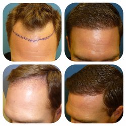 hair transplant Islamabad