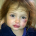 Photos: 3year old girl beaten black and blue by 2 year old classmate 