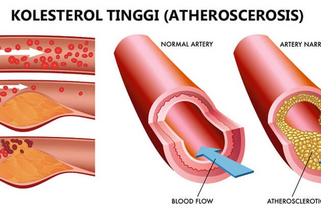 darah bekam kolesterol yang sering terlewatkan