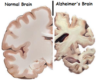 Tahapan penyakit Alzheimer