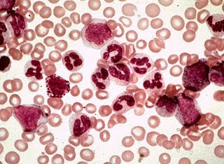 Leukemia Diagnosis