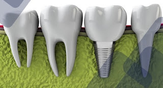 Cấy ghép implant giá rẻ -1