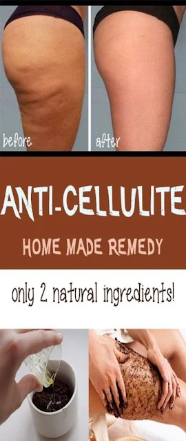 This Anti-Cellulite Remedy Is The First One That Actually Works