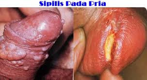 Obat Sipilis Luka Di Area Penis