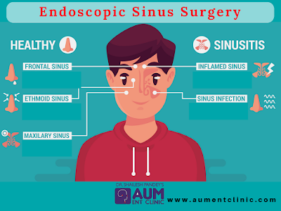 http://www.aumentclinic.com/sinus-surgery.php