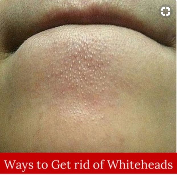 Get Rid of Whiteheads in 48 Hours || Health Care Solutions 