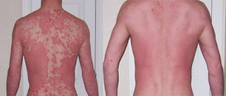 remedies for psoriasis picture